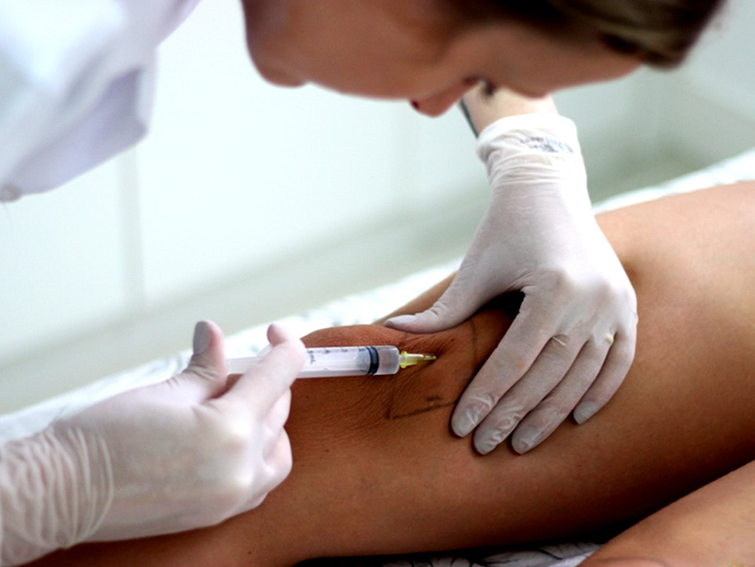 Barriga Lipo Enzimática Barriga Aplicação De Enzimas Antes E Depois Aplicacao De Enzimas Na Vila Formosa