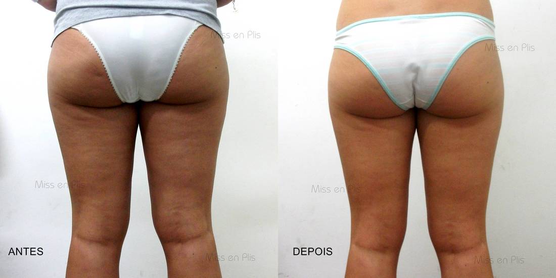 CELULITE VILA CALIFÓRNIA