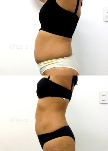 CRIOLIPÓLISE OU LIPOCAVITAÇÃO?