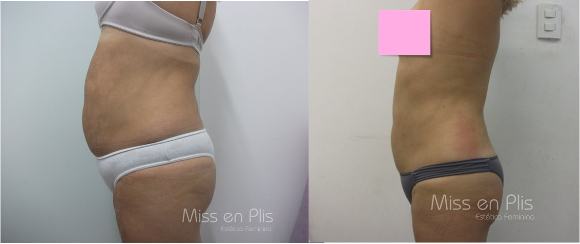 GORDURA LOCALIZADA NA VILA CALIFÓRNIA