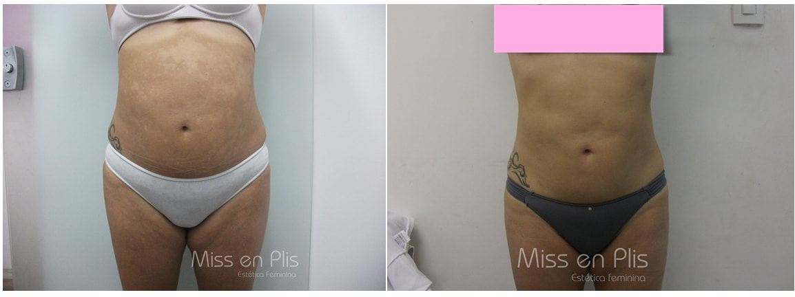 GORDURA LOCALIZADA NA VILA EMA