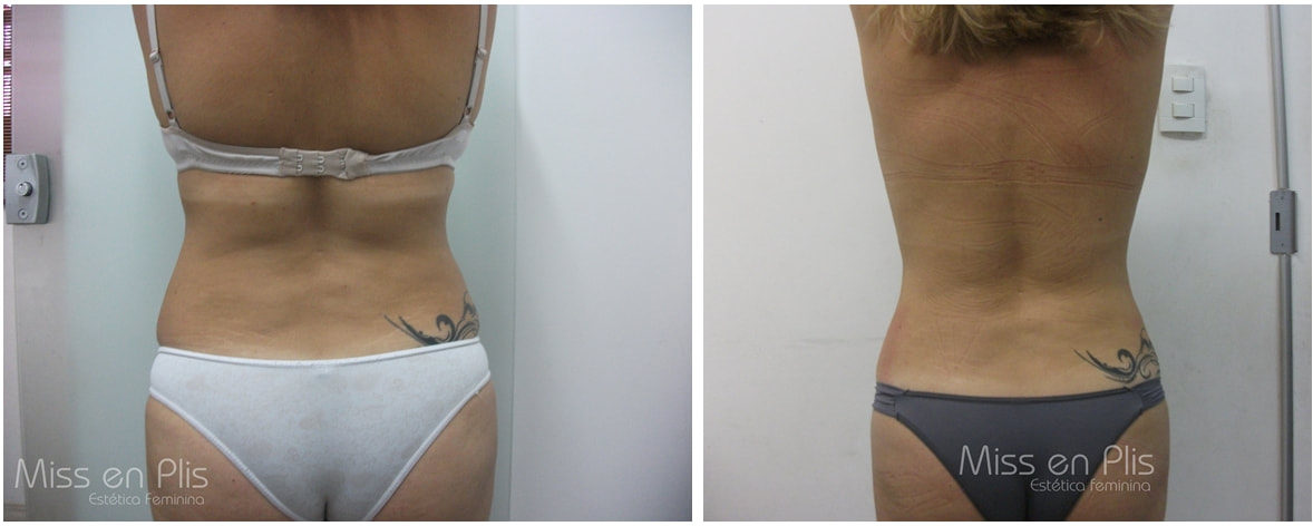 GORDURA LOCALIZADA NO JARDIM INDEPENDÊNCIA