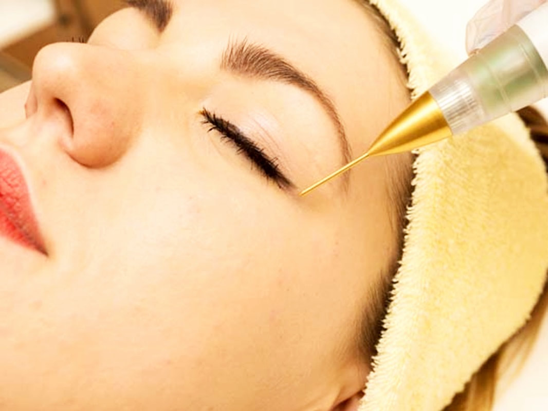  BLEFAROPLASTIA COM PLASMA NO JARDIM INDEPENDÊNCIA