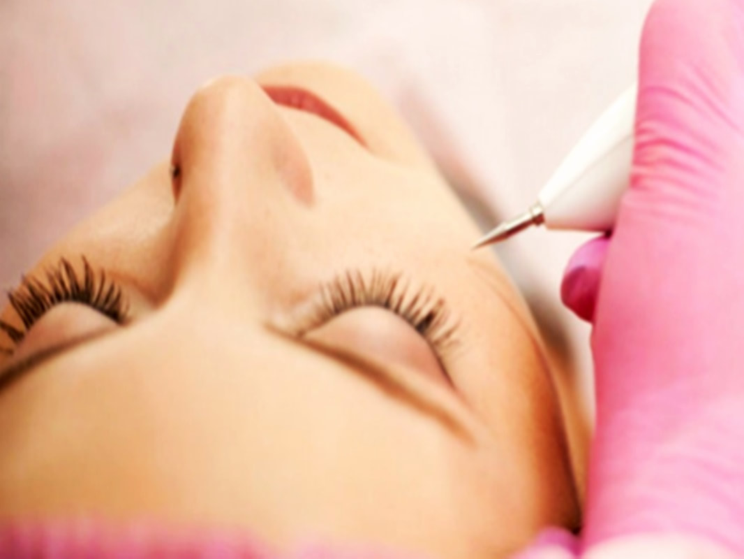  BLEFAROPLASTIA COM PLASMA NO JARDIM INDEPENDÊNCIA