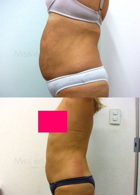 LIPOCAVITAÇÃO ANTES E DEPOIS
