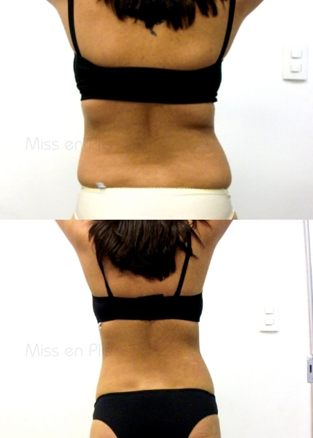 LIPOCAVITAÇÃO FUNCIONA?