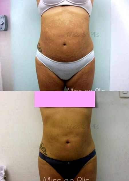 LIPOCAVITAÇÃO FUNCIONA?