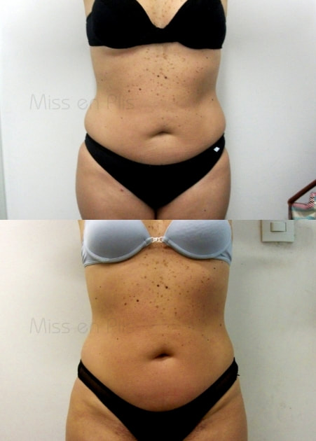 LIPOCAVITAÇÃO ONDE FAZER