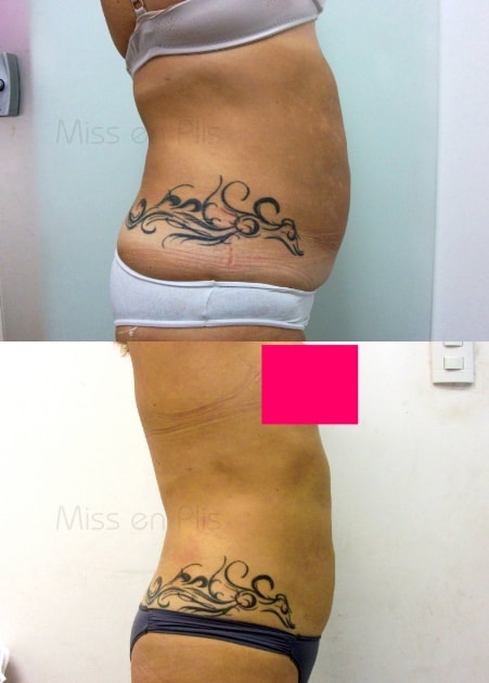 LIPOCAVITAÇÃO PREÇO