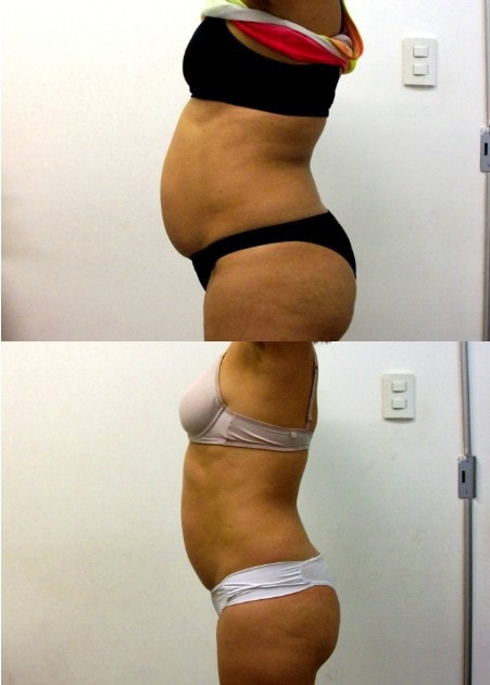 LIPOCAVITAÇÃO ANTES E DEPOIS