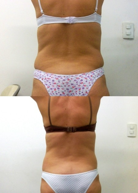 LIPOCAVITAÇÃO CLÍNICA