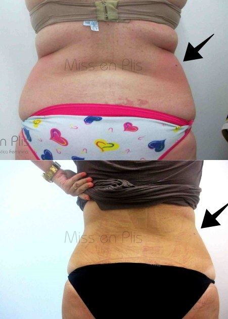 LIPOCAVITAÇÃO EMAGRECE?