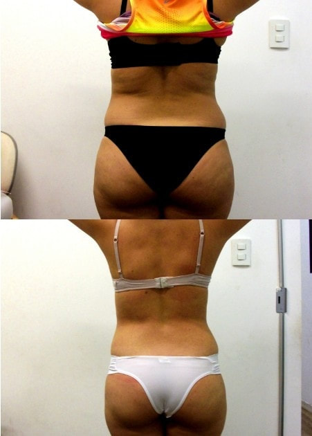 LIPOCAVITAÇÃO FUNCIONA?