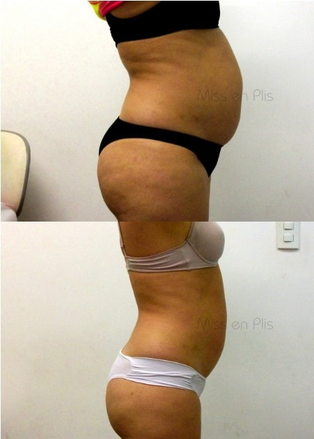 LIPOCAVITAÇÃO VALOR