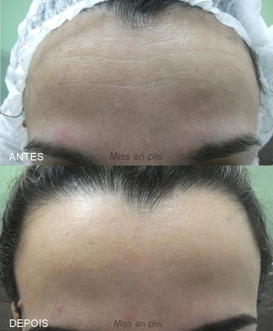 MICROAGULHAMENTO EM SÃO PAULO