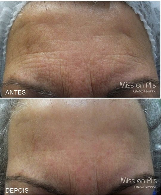 RADIOFREQUÊNCIA NA VILA ALPINA