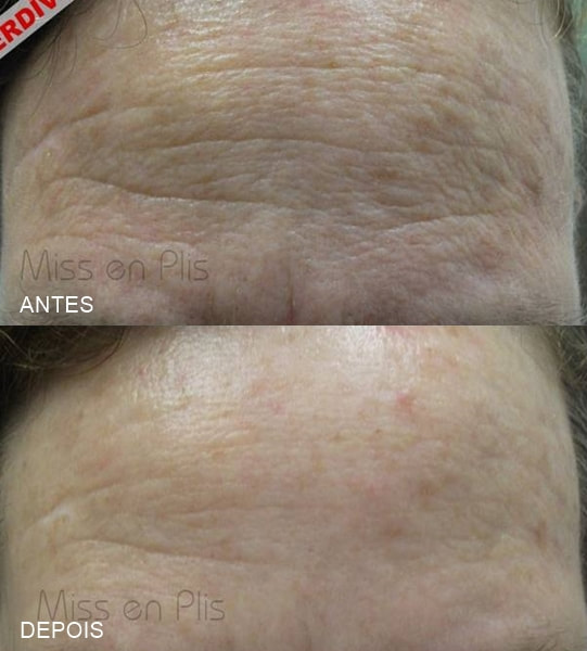 ONDE FAZER MICROAGULHAMENTO NA VILA ZELINA