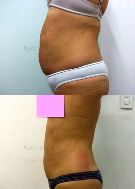 LIPOCAVITAÇÃO O QUE É?