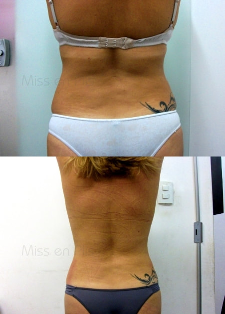 O QUE É LIPOCAVITAÇÃO?