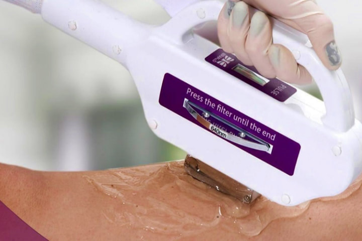 DEPILAÇÃO A LASER É DEFINITIVA?