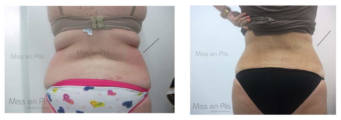 REDUÇÃO DE MEDIDAS NA MOOCA