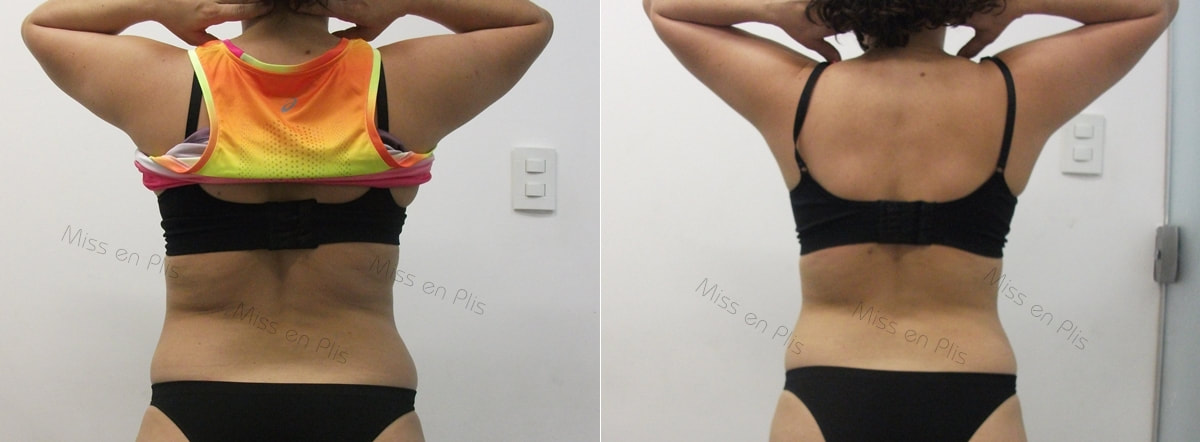 REDUÇÃO DE MEDIDAS NO TATUAPÉ