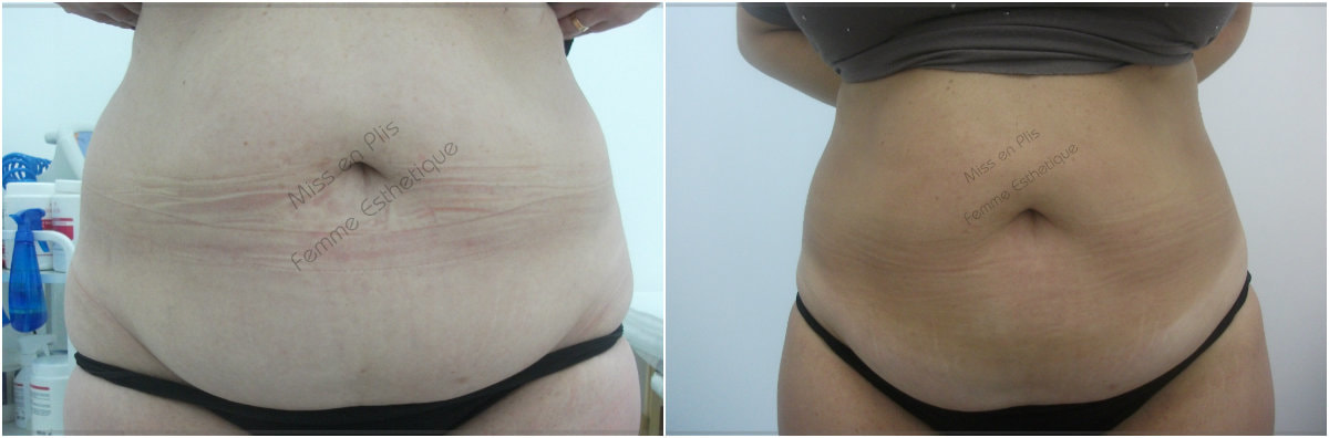 REDUÇÃO DE MEDIDAS NO TATUAPÉ