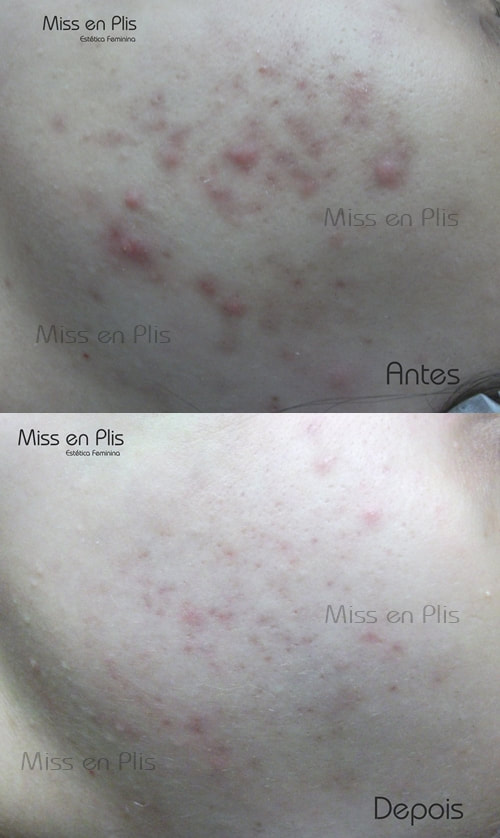 TRATAMENTO PARA ACNE NO IPIRANGA