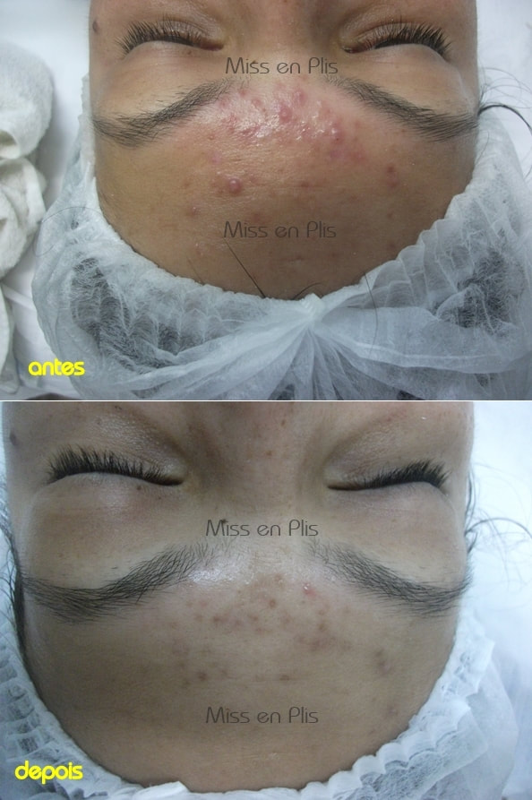 TRATAMENTO PARA ACNE NO JARDIM AVELINO