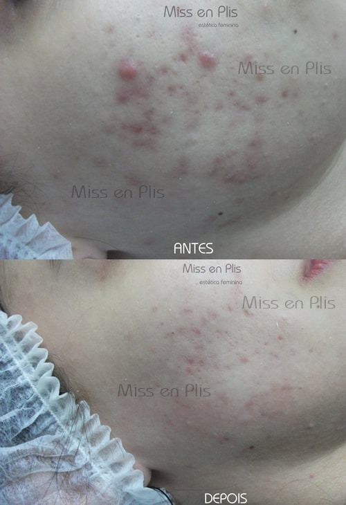 TRATAMENTO PARA ACNE EM SÃO CAETANO DO SUL